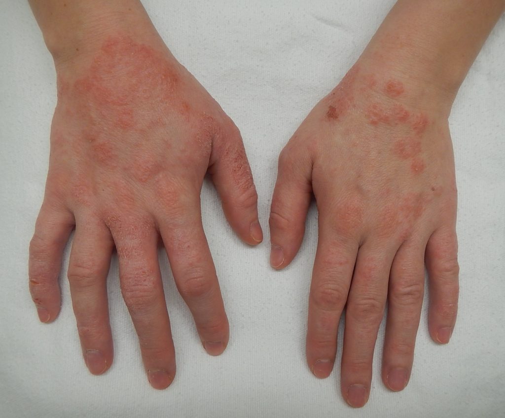 Eczema modéré sur mains